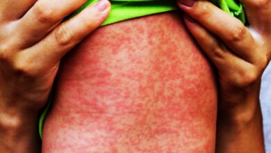 Em Vitória da Conquista, a Vigilância Epidemiológica (Viep) da Secretaria Municipal de Saúde (SMS), registrou, neste ano, 11 casos suspeitos de sarampo, dos quais nove foram descartados e dois ainda estão em investigação laboratorial. Por isso, a Viep emitiu um alerta para as unidades de saúde e tem reforçado a recomendação para que os profissionais de saúde e a população estejam em total alerta para qualquer caso suspeito de doença exantemática febril, relacionadas à erupções na pele.